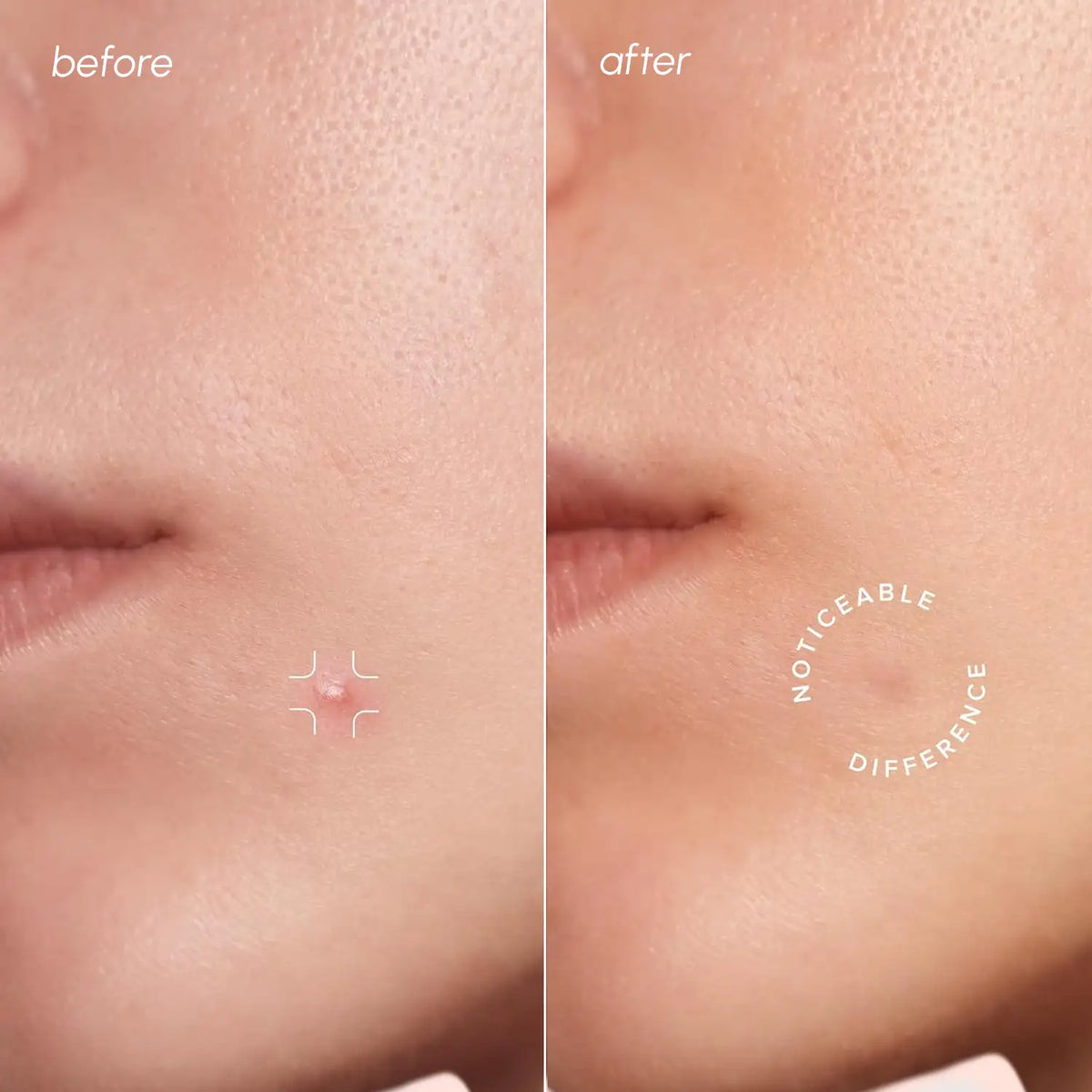 Invisible Pimple & Acne Patches — image 2