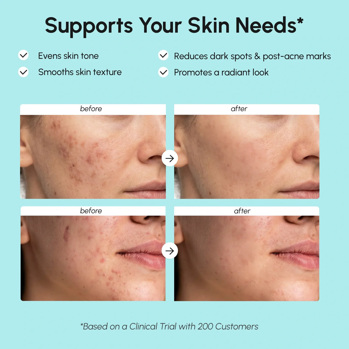 Azelaic Acid Cream for Sensitive Skin — image 3