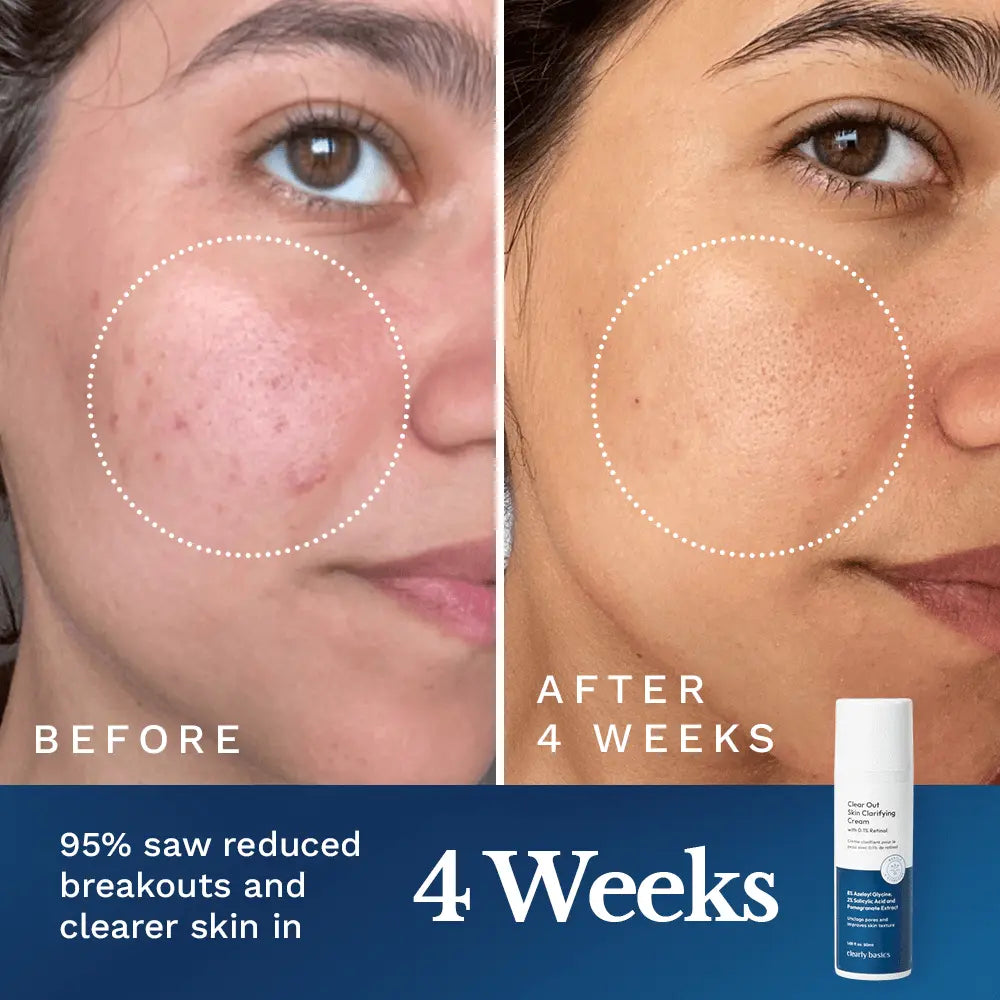 Clear Out Skin Clarifying Cream — image 3