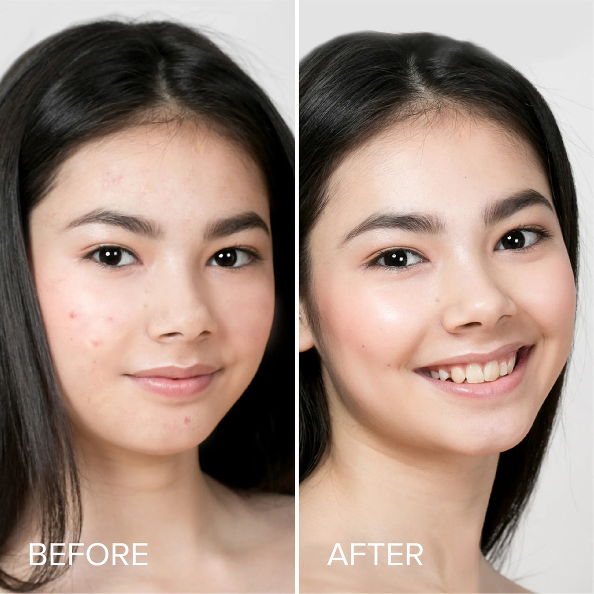 Pimple & Acne Patches — image 3