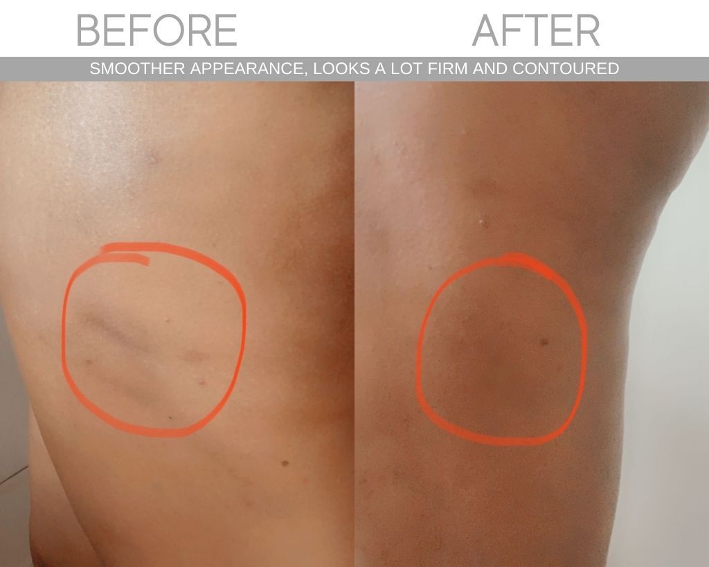 Cellulite Cupping Set - SCULPT — image 3