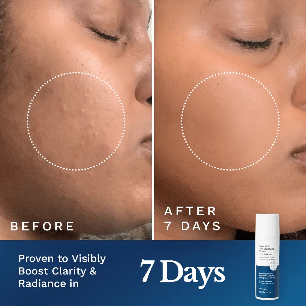Clear Out Skin Clarifying Cream — image 4