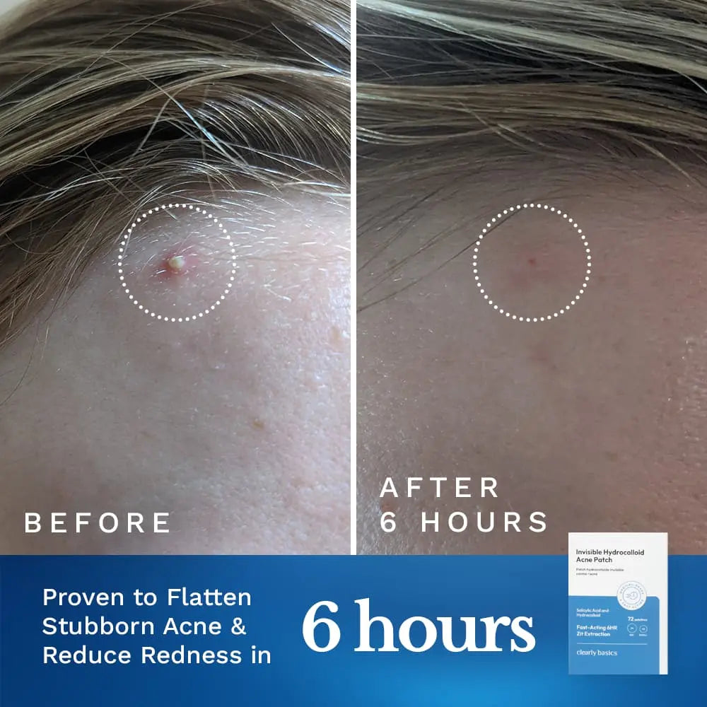 Invisible Acne Patch — image 3