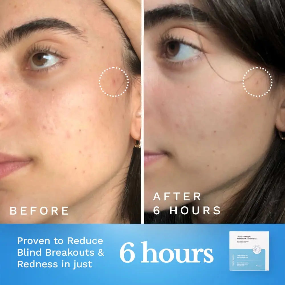 Ultra-Strength Microdart Acne Patch — image 3
