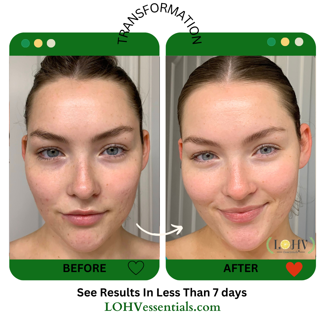 PREMIUM 100% VEGAN HYPER HYDRATOR Face Moisturizer With SPF 30 + Hyaluronic Acid + Lactic acid + Vitamin C + Kombucha — image 3