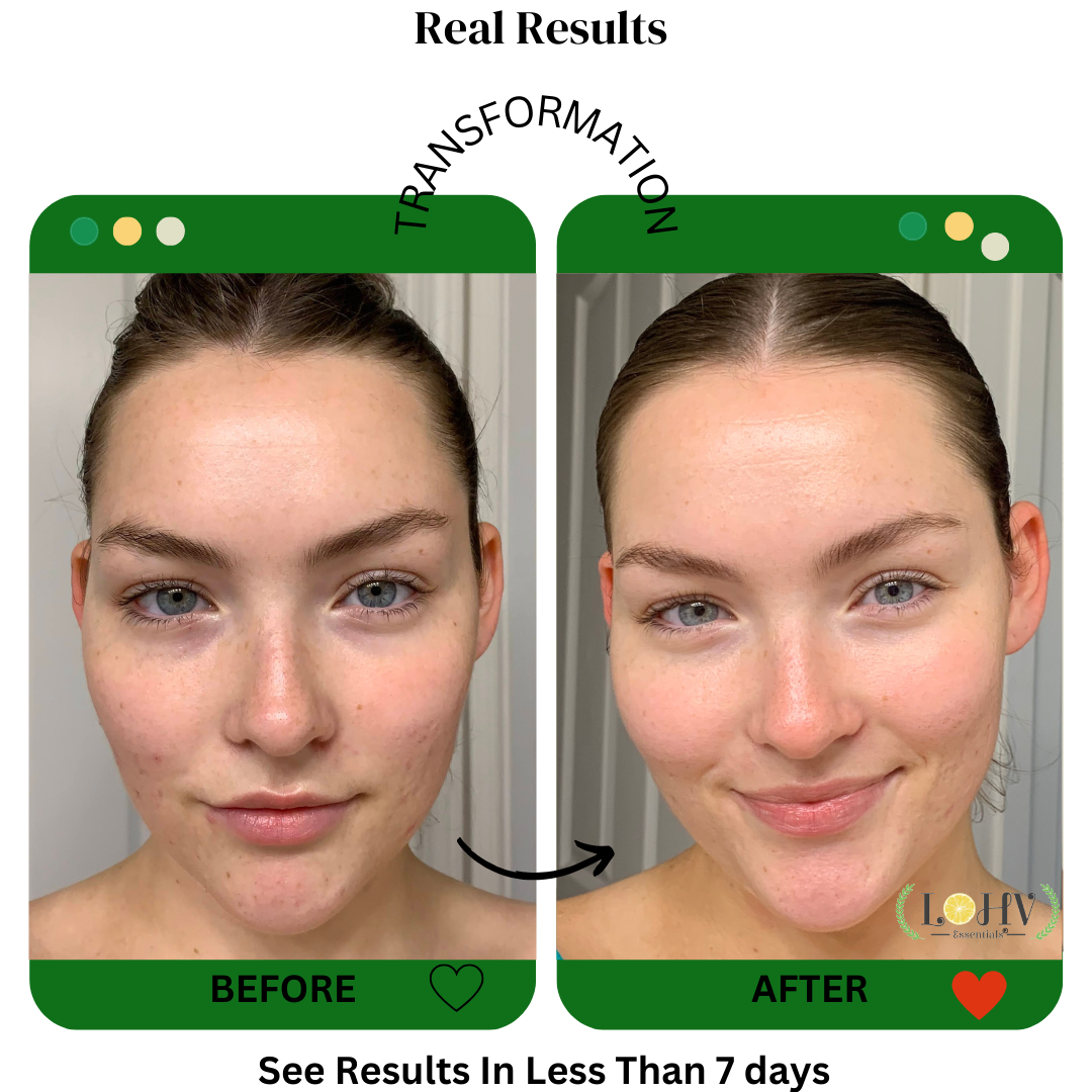 4 STEP PREMIUM 100% VEGAN SKINCARE SOLUTION SYSTEM With Rosemary + Hyaluronic acid + Vitamin C + Retinol + Lactic acid + Glycolic acid + Vitamin E + Niacinamide + Kombucha + Aloe vera