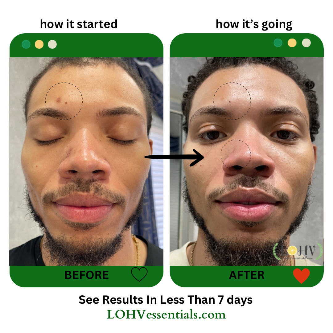 4 STEP PREMIUM 100% VEGAN SKINCARE SOLUTION SYSTEM With Rosemary + Hyaluronic acid + Vitamin C + Retinol + Lactic acid + Glycolic acid + Vitamin E + Niacinamide + Kombucha + Aloe vera